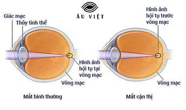 cận 1 mắt có nên đeo kính